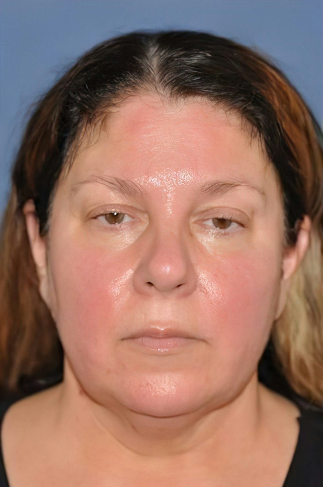 Dr. David A. Sherris's Patient Before facelift
