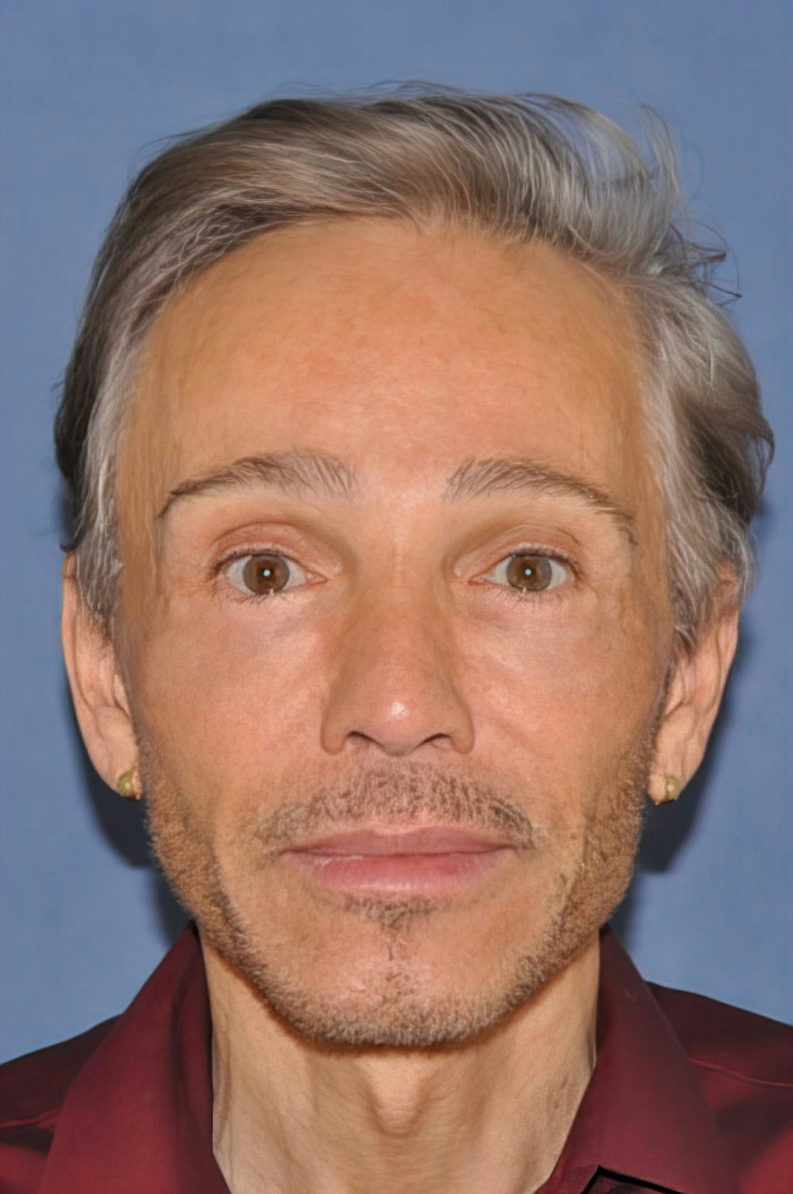Dr. David A. Sherris's Patient After facelift