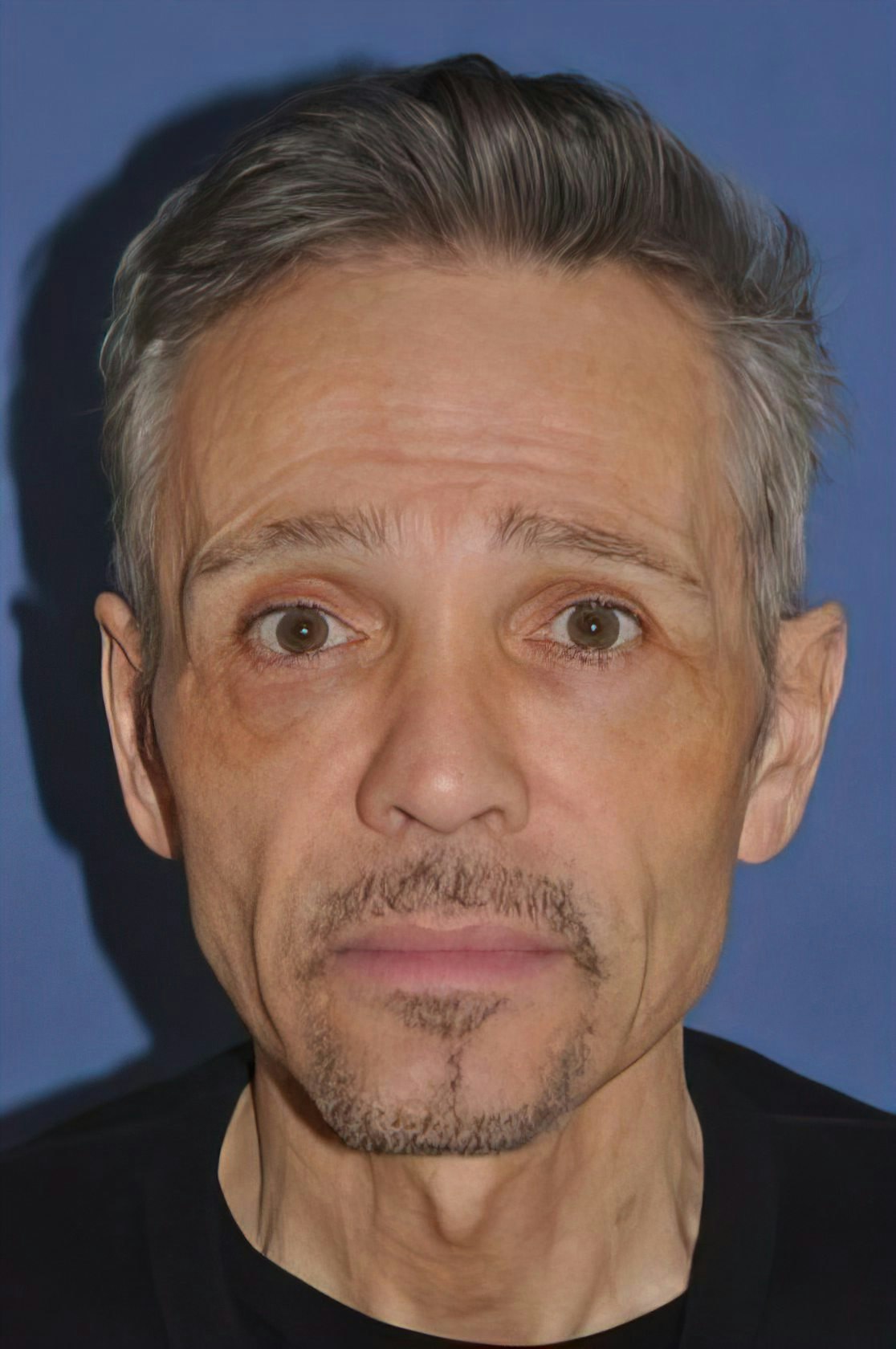 Dr. David A. Sherris's Patient Before facelift