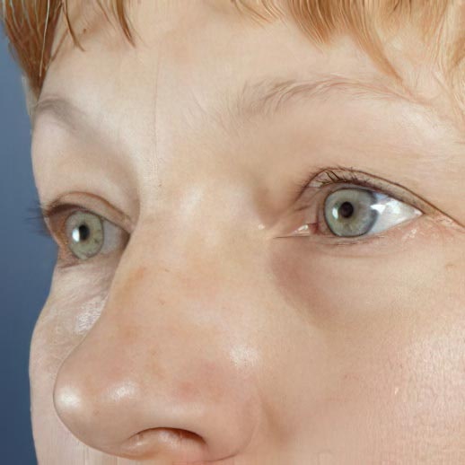 Before eyelid surgery