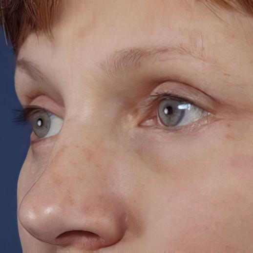 After eyelid surgery