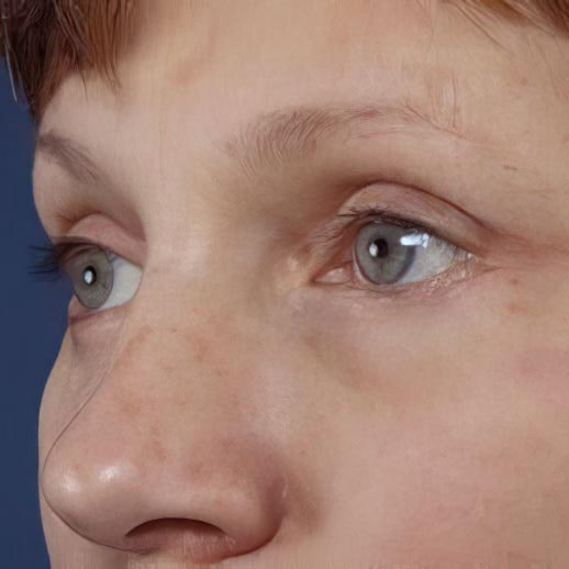 After eyelid surgery