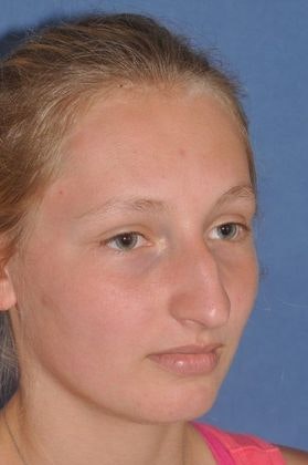 Before rhinoplasty