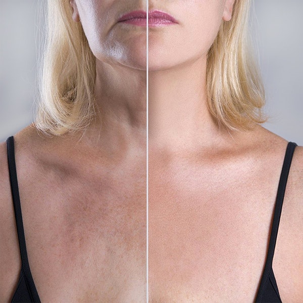 Neck lift before and after