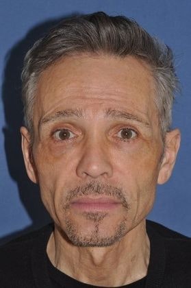 Before plastic surgery