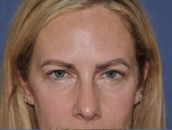 Before endoscopic brow lift