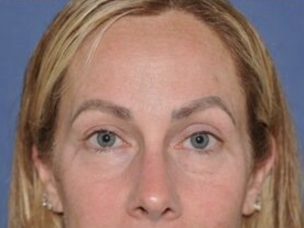 After endoscopic brow lift