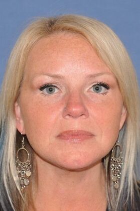 Dr. David A. Sherris' patient after a facelift