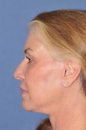 after deep plane facelift