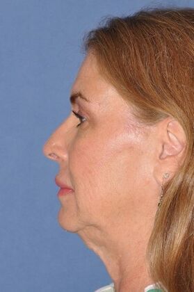Dr. David A. Sherris' patient before a deep plane facelift