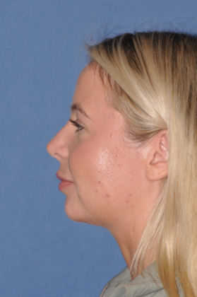 Dr. David A. Sherris' patient after a neck lift