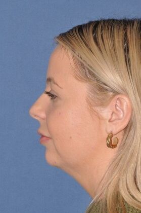 Dr. David A. Sherris' patient before a neck lift