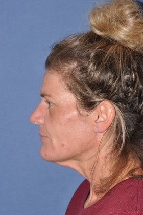 Dr. Sherris's patient before deep plane facelift