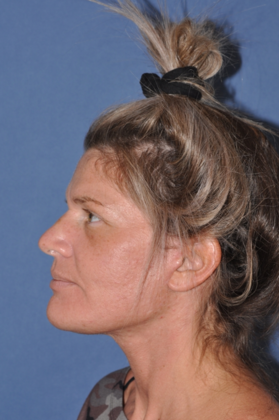 Dr. Sherris's patient after deep plane facelift