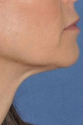 Before mini facelift