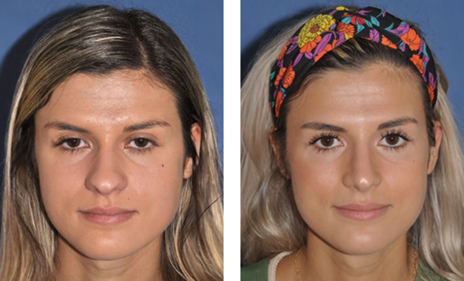 Before and after a severe nasal valve collapse