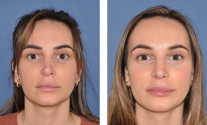 Rib graft revision rhinoplasty after 5 months