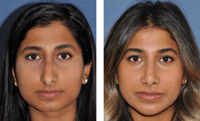 Before and after ethnic rhinoplasty