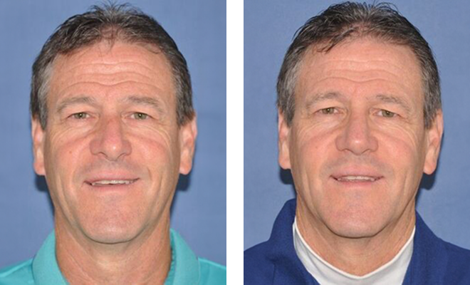 Before and after male rhinoplasty