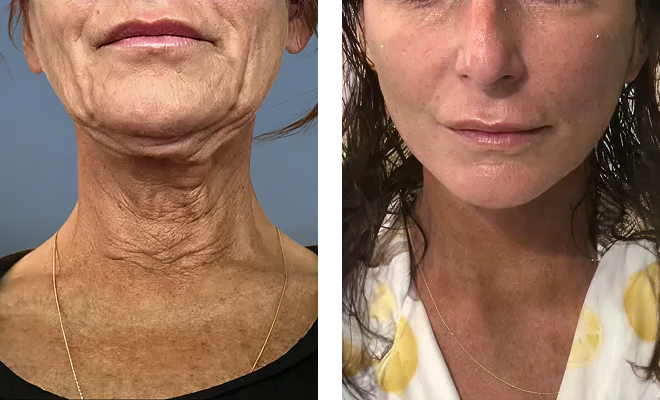 Minilift with necklift