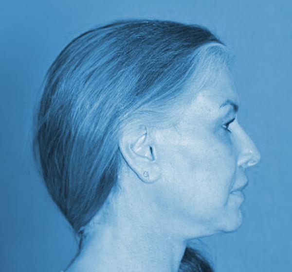 woman after a deep plane facelift