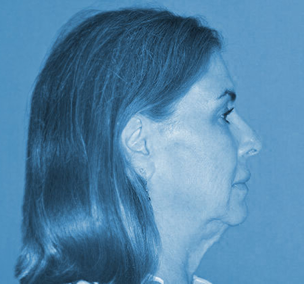 woman before a deep plane facelift