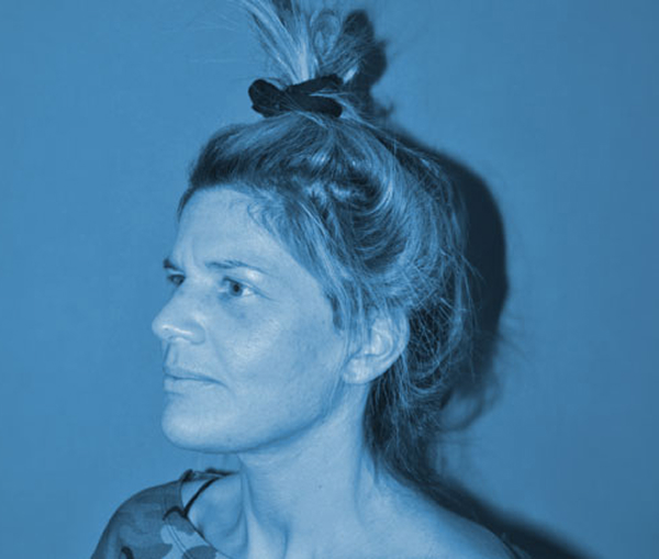 woman after facelift