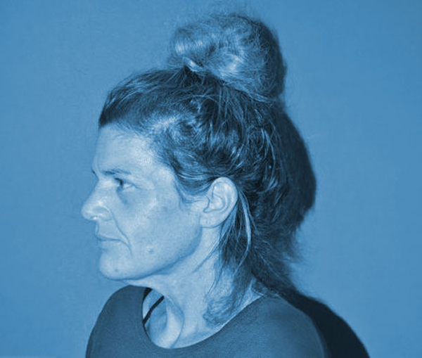 woman before facelift