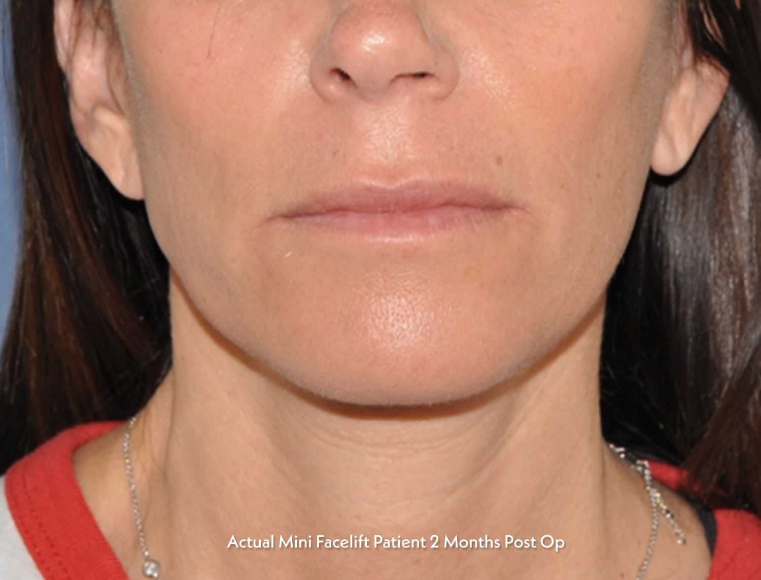 mini facelift patient 2 months post op