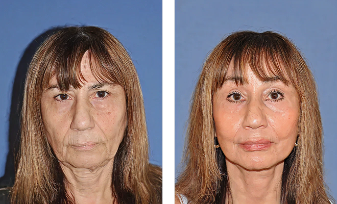 Facelift, browliftt, lower lids with fat transposition, dermabrasion around the mouth and SMAS implant to lips