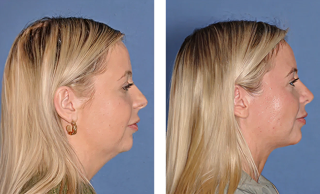 Deep Neck Lift with Liposuction in a young patient