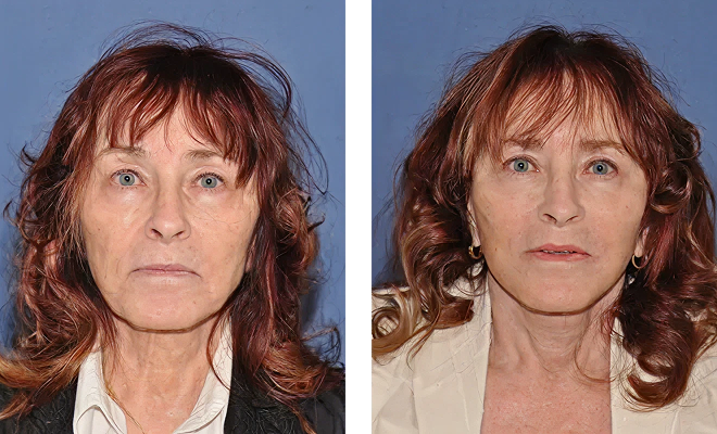 Deep Plane second Face and Neck Lift and Upper lid Lift