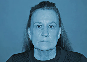 A woman before a deep plane facelift