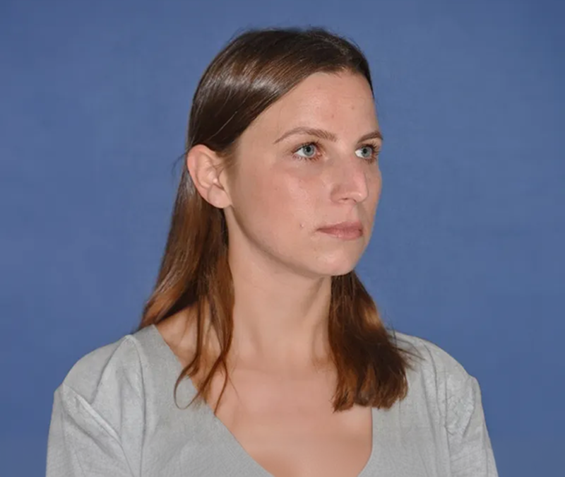 Patient before rhinoplasty