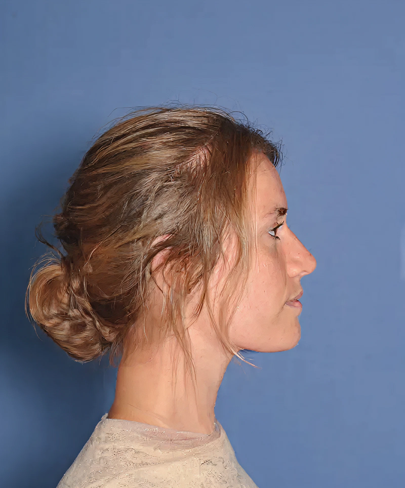 Patient after rhinoplasty