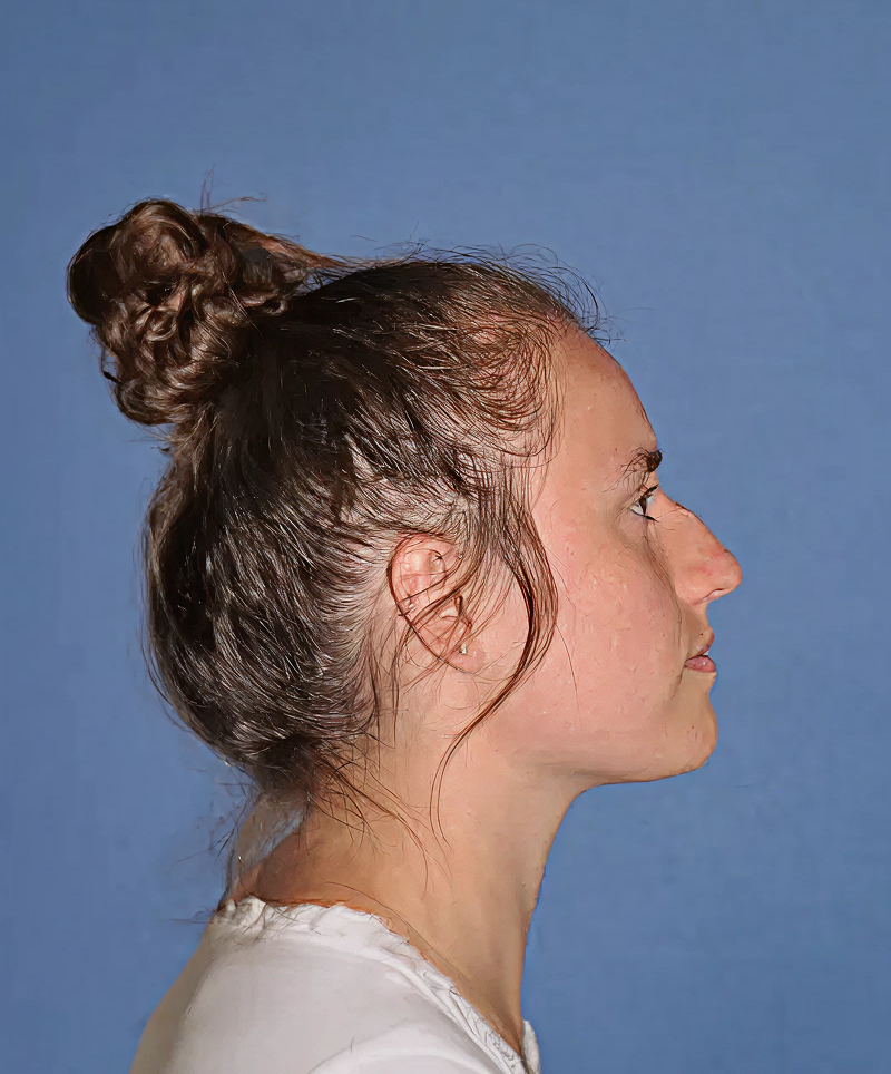 Patient before rhinoplasty