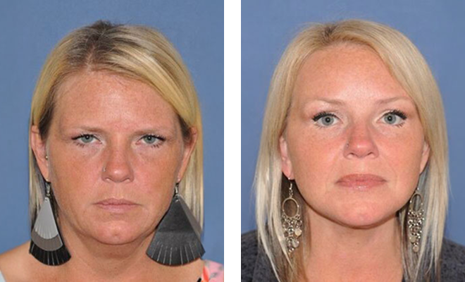 Browlift with upper and lower eyelids