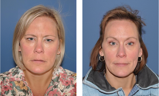 Endoscopic Browlift and Upper Lids revealing lovely natural eye shape