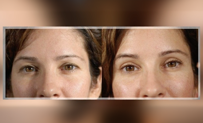 Real patient before and after blepharoplasty