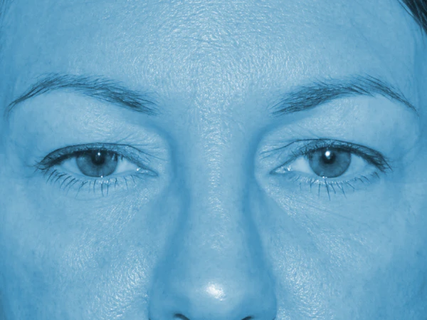 Buffalo patient before upper blepharoplasty