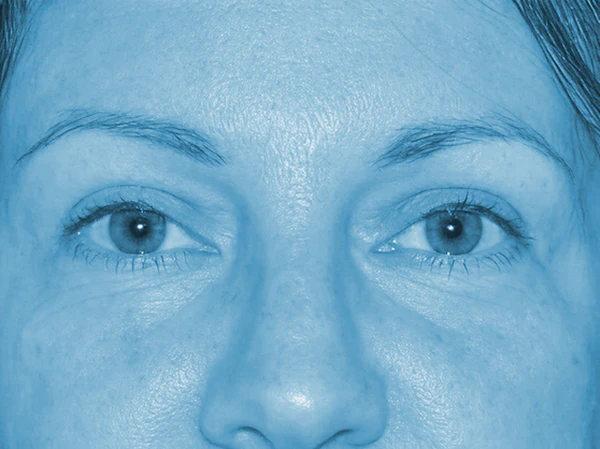 Buffalo patient after upper blepharoplasty