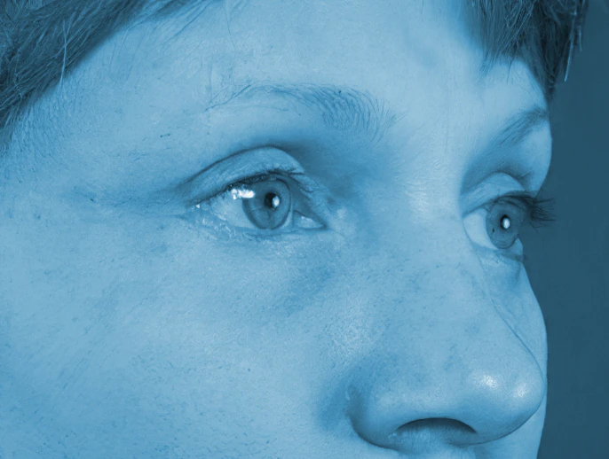 Buffalo patient after blepharoplasty