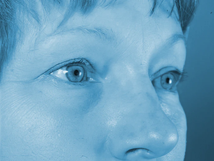 Buffalo patient before blepharoplasty