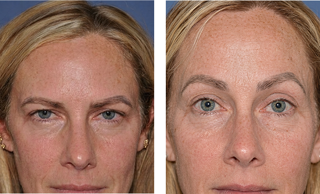 Dr. Sherris' brow lift patient before and after