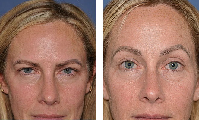 Dr. Sherris' brow lift patient before and after