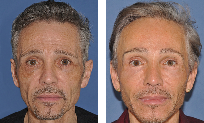 Dr. Sherris' brow lift patient before and after