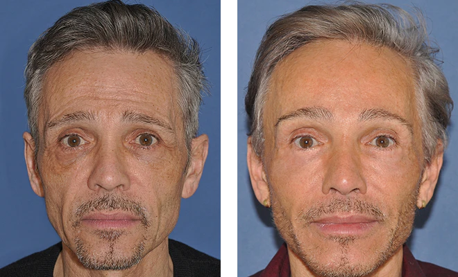 Dr. Sherris' brow lift patient before and after