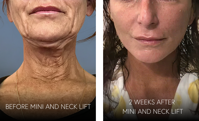 Before and 2 weeks after a mini facelift and neck lift