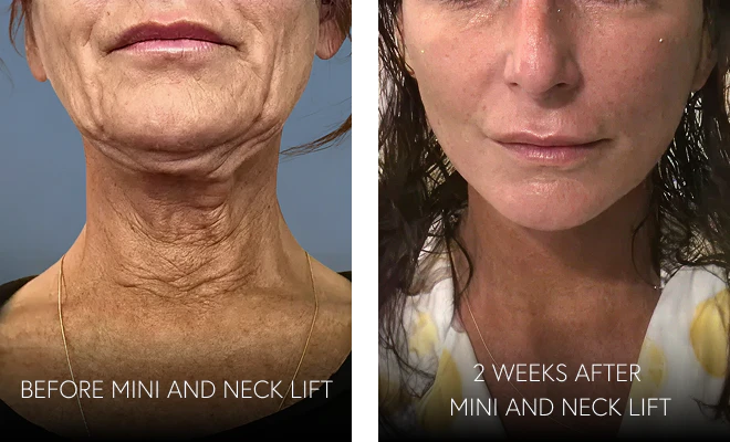 Before and 2 weeks after a mini facelift and neck lift