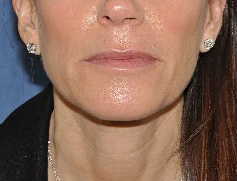 Before mini facelift